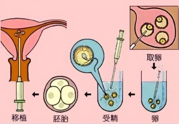 供卵代孕方法